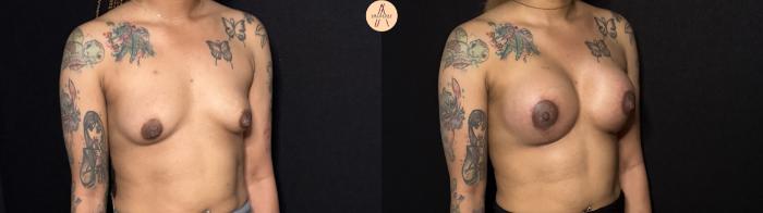 Before & After Breast Augmentation Case 442 Right Oblique View in San Antonio, Texas