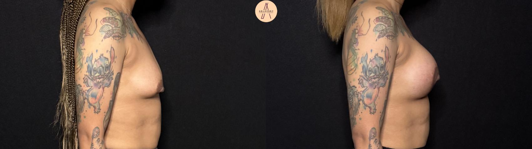 Before & After Breast Augmentation Case 442 Right Side View in San Antonio, Texas