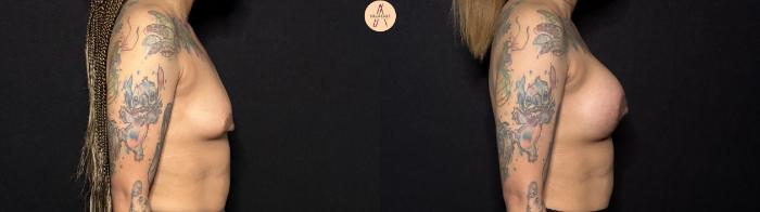 Before & After Breast Augmentation Case 442 Right Side View in San Antonio, Texas
