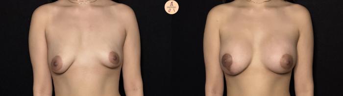 Before & After Breast Augmentation Case 443 Front View in San Antonio, Texas
