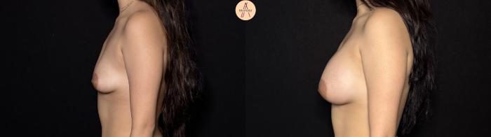 Before & After Breast Augmentation Case 443 Left Side View in San Antonio, Texas