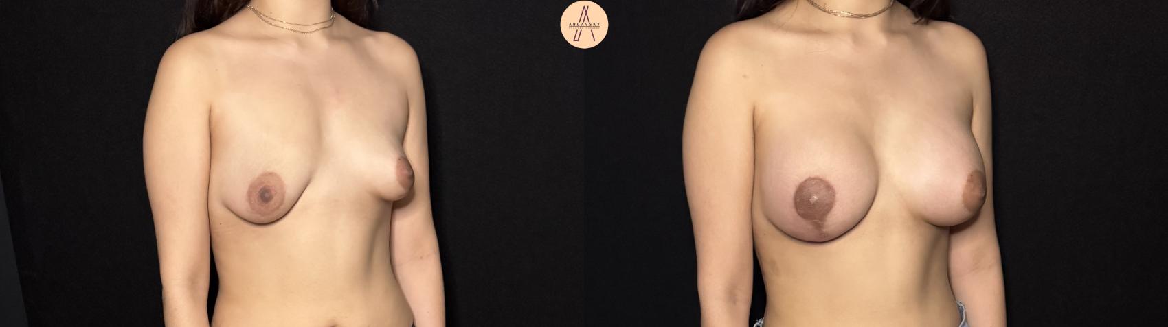 Before & After Breast Augmentation Case 443 Right Oblique View in San Antonio, Texas