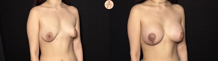 Before & After Breast Augmentation Case 443 Right Oblique View in San Antonio, Texas