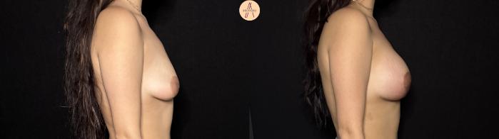 Before & After Breast Augmentation Case 443 Right Side View in San Antonio, Texas