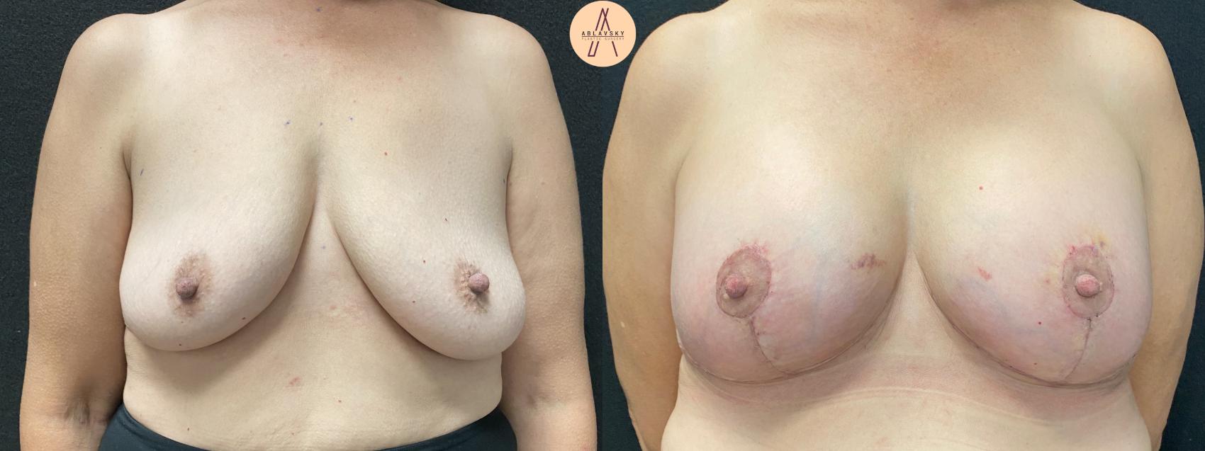 Before & After Breast Lift Case 47 Front View in San Antonio, Texas