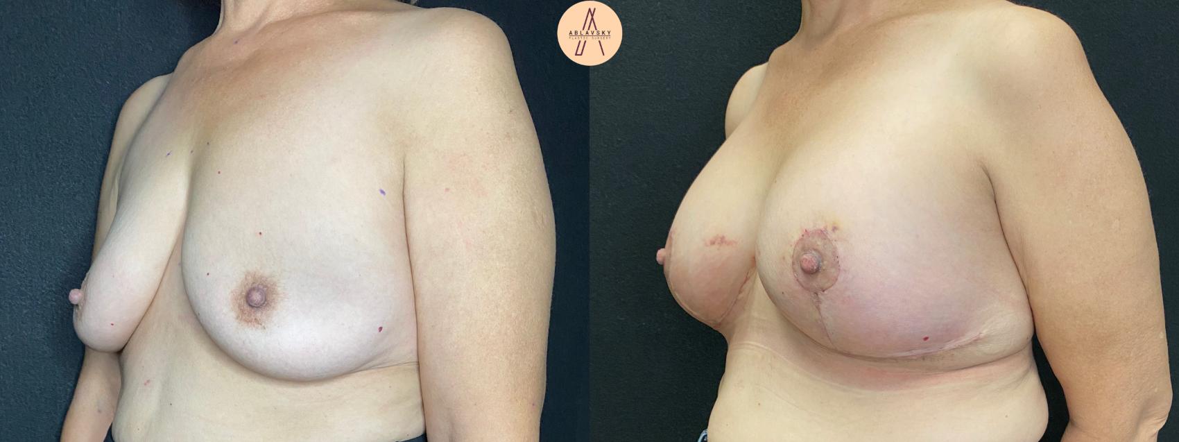 Before & After Breast Lift Case 47 Left Oblique View in San Antonio, Texas