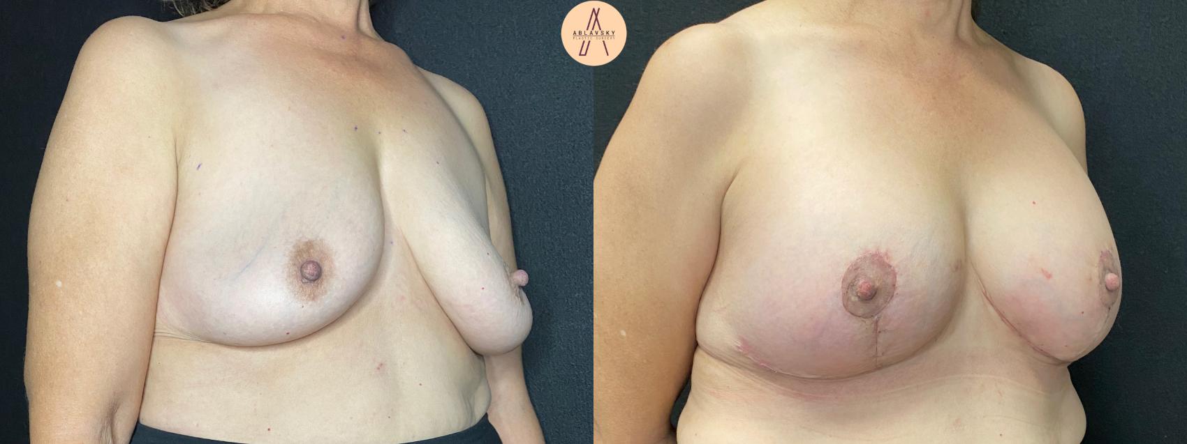 Before & After Breast Lift Case 47 Right Oblique View in San Antonio, Texas