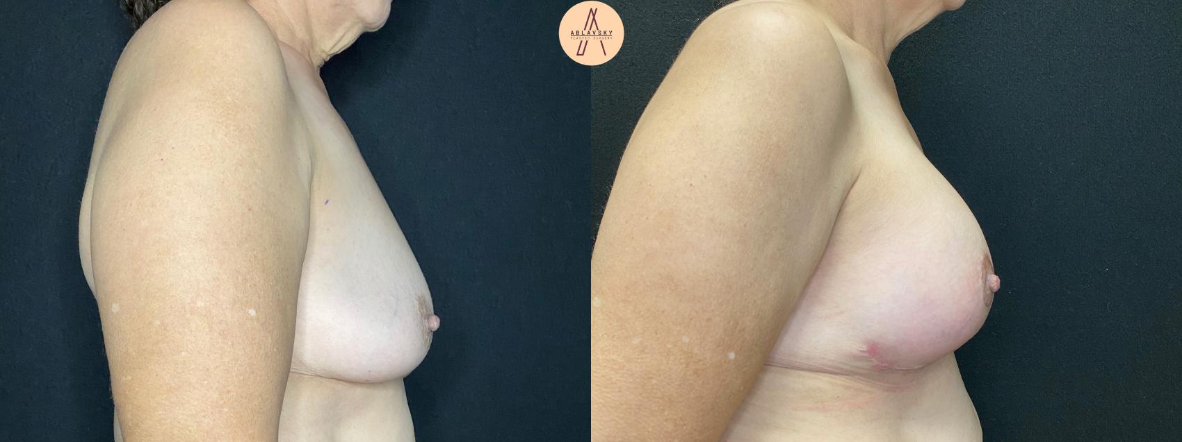 Before & After Breast Lift Case 47 Right Side View in San Antonio, Texas