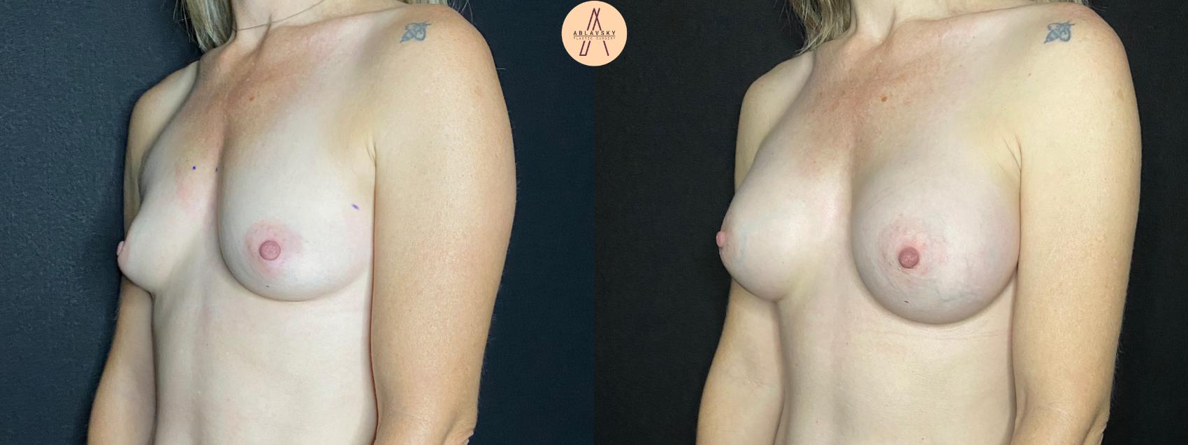 Before & After Breast Augmentation Case 50 Left Oblique View in San Antonio, Texas