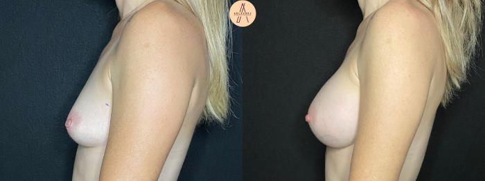 Before & After Breast Augmentation Case 50 Left Side View in San Antonio, Texas