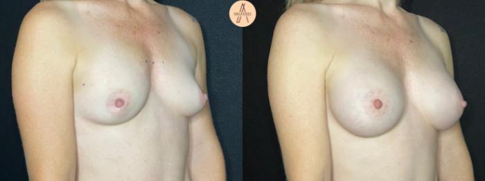 Before & After Breast Augmentation Case 50 Right Oblique View in San Antonio, Texas