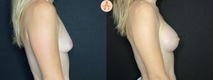 Before & After Breast Augmentation Case 50 Right Side View in San Antonio, Texas
