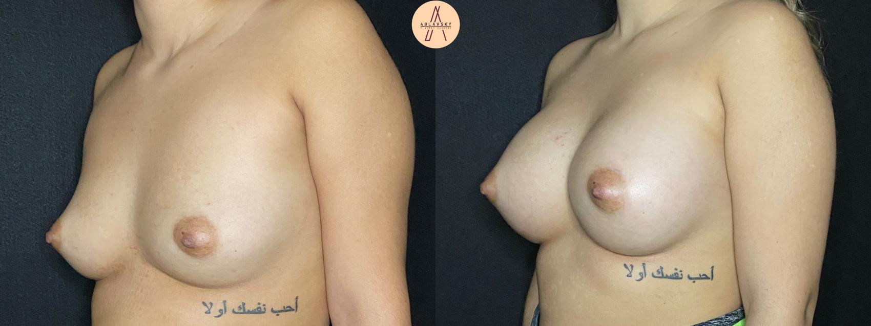 Before & After Breast Augmentation Case 52 Left Oblique View in San Antonio, Texas