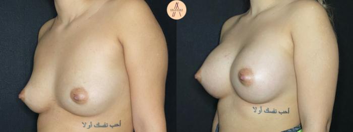Before & After Breast Augmentation Case 52 Left Oblique View in San Antonio, Texas