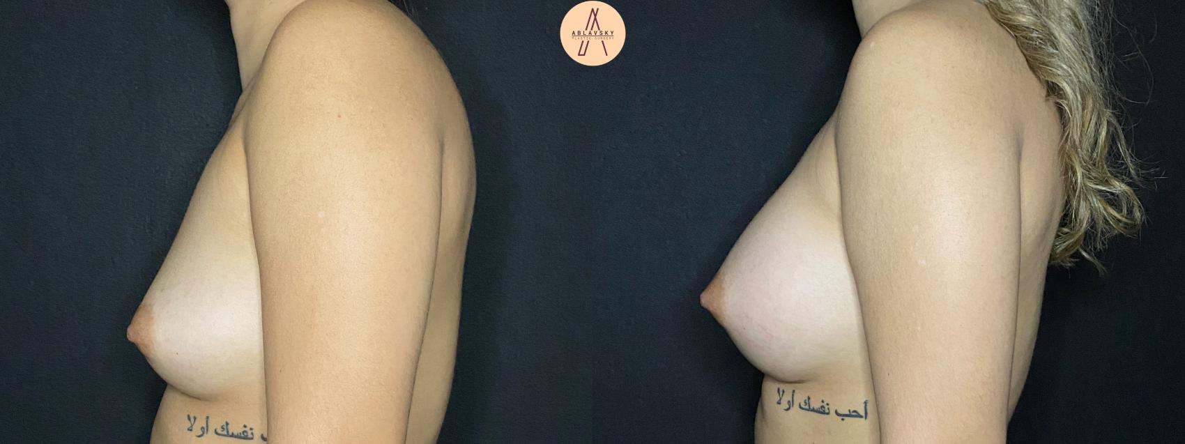 Before & After Breast Augmentation Case 52 Left Side View in San Antonio, Texas