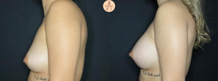 Before & After Breast Augmentation Case 52 Left Side View in San Antonio, Texas