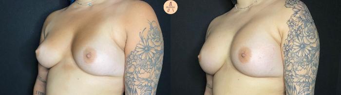 Before & After Breast Augmentation Case 66 Left Oblique View in San Antonio, Texas