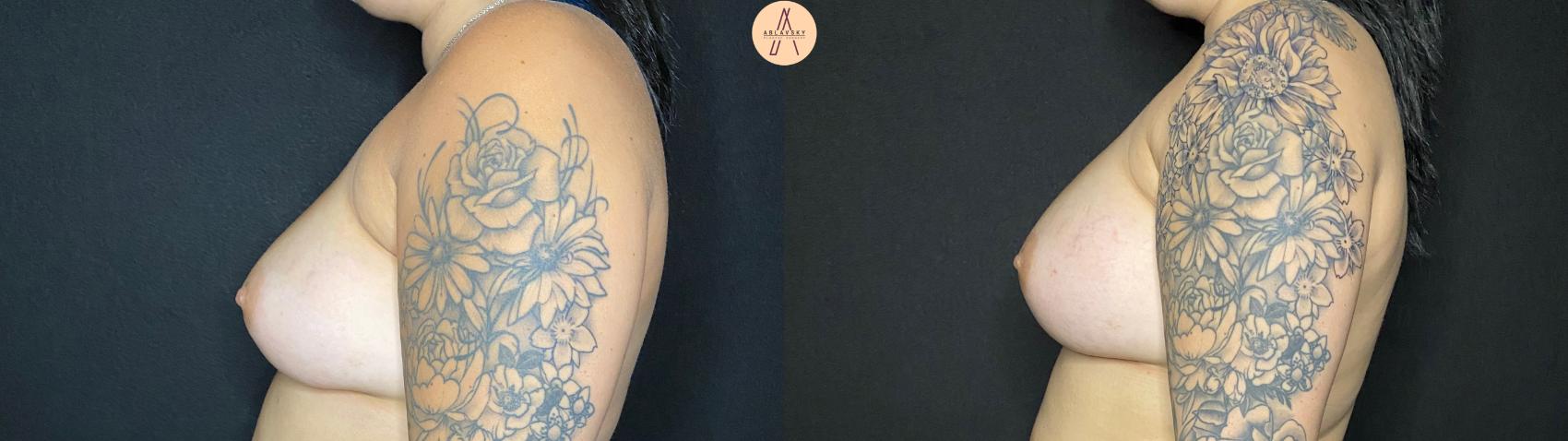 Before & After Breast Augmentation Case 66 Left Side View in San Antonio, Texas