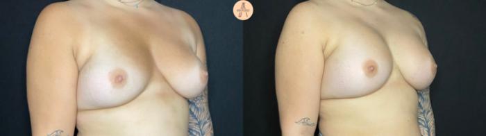 Before & After Breast Augmentation Case 66 Right Oblique View in San Antonio, Texas