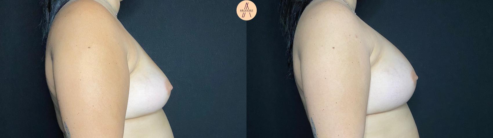 Before & After Breast Augmentation Case 66 Right Side View in San Antonio, Texas