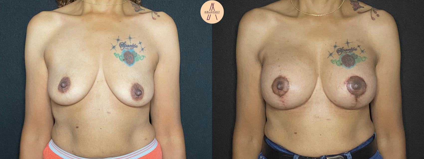 Before & After Breast Lift Case 67 Front View in San Antonio, Texas