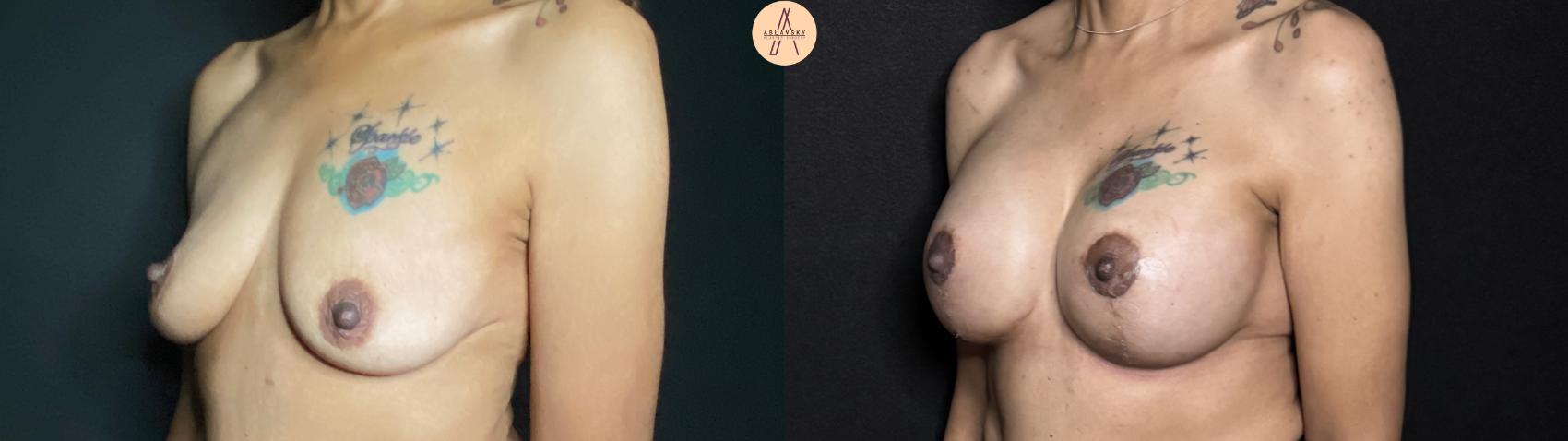 Before & After Breast Augmentation Case 67 Left Oblique View in San Antonio, Texas