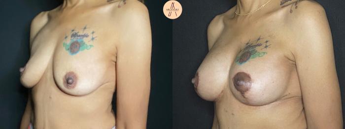 Before & After Breast Augmentation Case 67 Left Oblique View in San Antonio, Texas