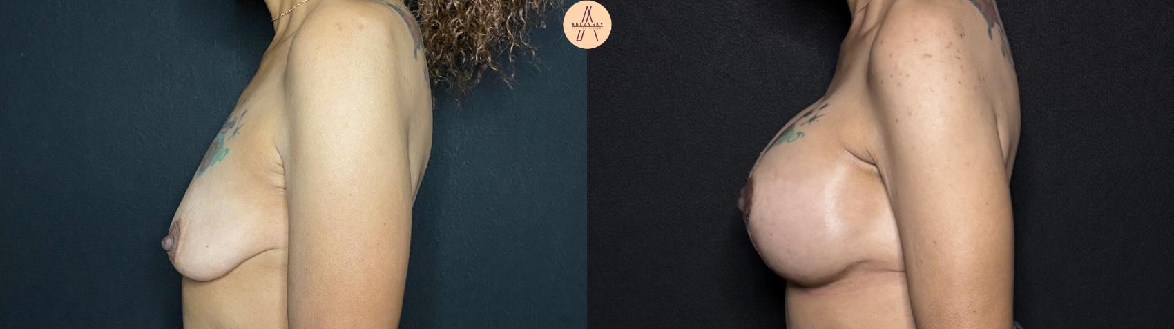 Before & After Breast Augmentation Case 67 Left Side View in San Antonio, Texas