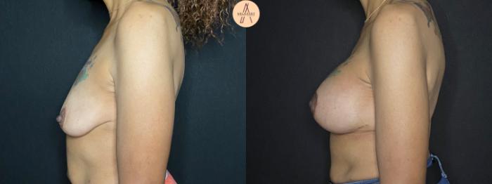 Before & After Breast Lift Case 67 Left Side View in San Antonio, Texas