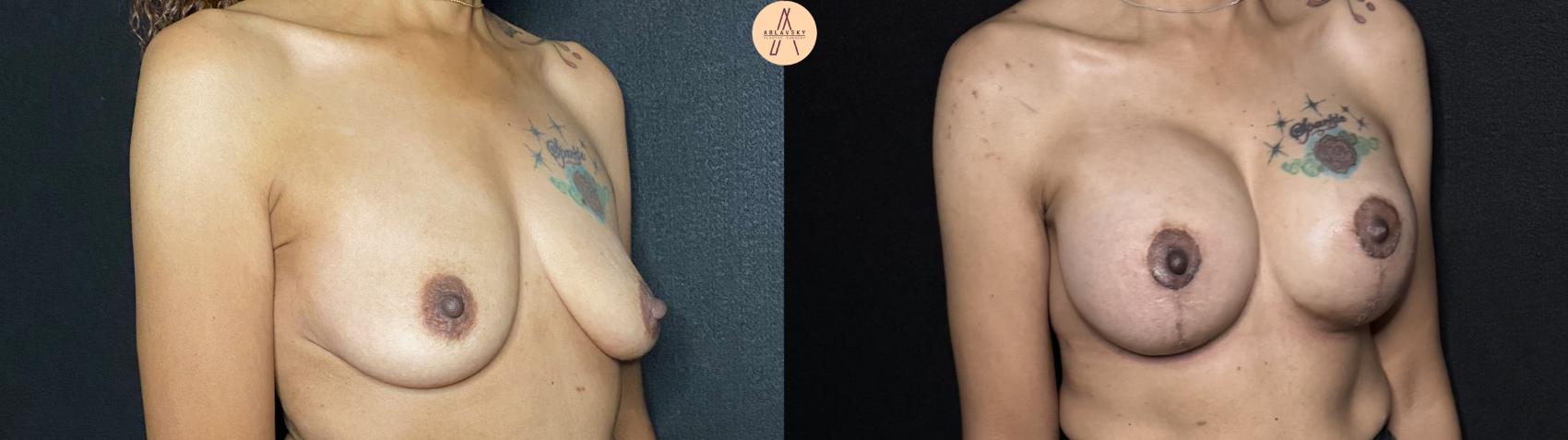 Before & After Breast Augmentation Case 67 Right Oblique View in San Antonio, Texas