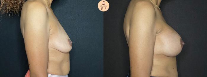 Before & After Breast Augmentation Case 67 Right Side View in San Antonio, Texas