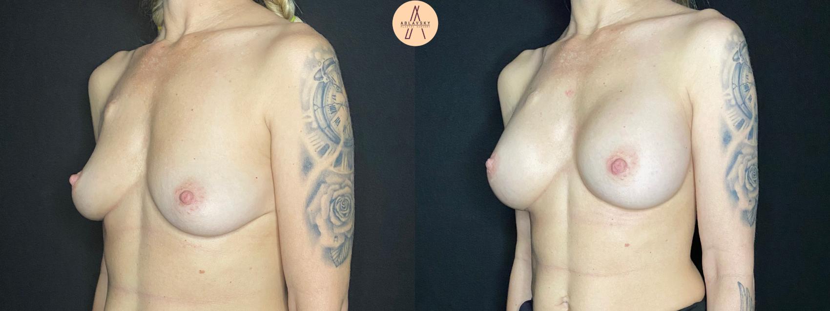 Before & After Breast Augmentation Case 72 Left Oblique View in San Antonio, Texas
