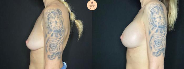 Before & After Breast Augmentation Case 72 Left Side View in San Antonio, Texas
