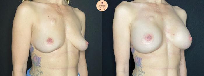 Before & After Breast Augmentation Case 72 Right Oblique View in San Antonio, Texas