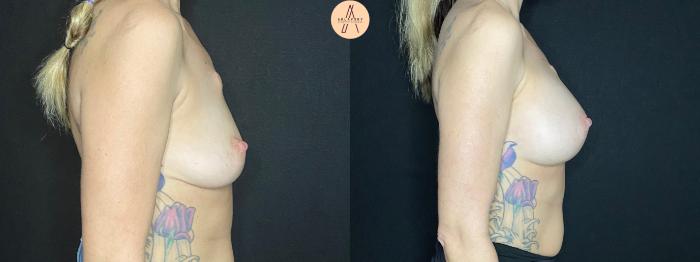 Before & After Breast Augmentation Case 72 Right Side View in San Antonio, Texas