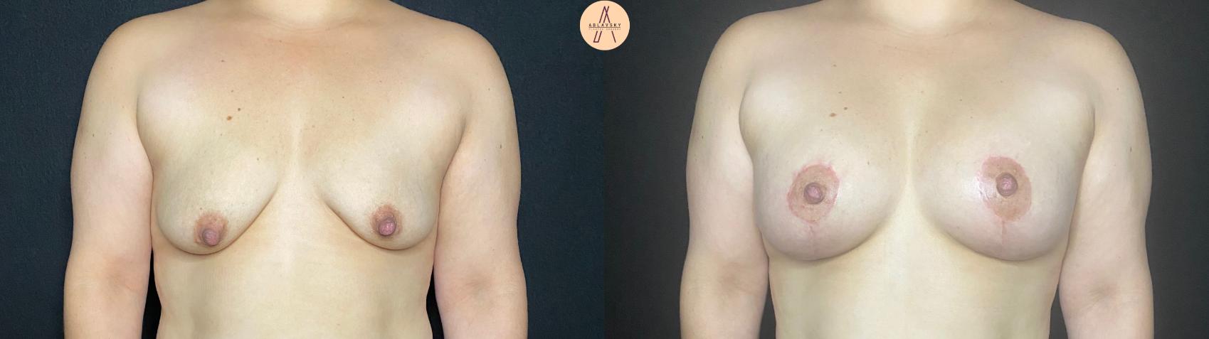 Before & After Breast Augmentation Case 73 Front View in San Antonio, Texas