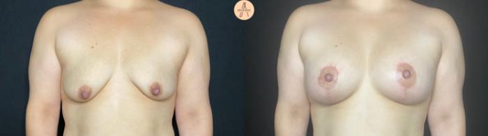 Before & After Breast Augmentation Case 73 Front View in San Antonio, Texas