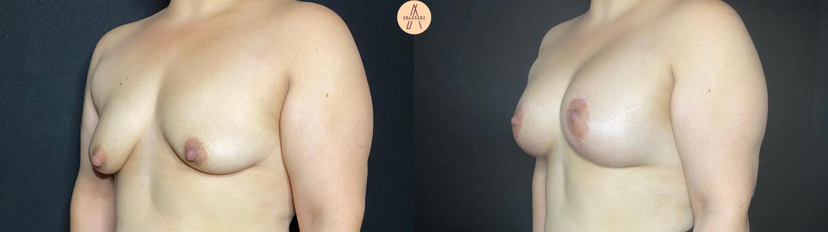 Before & After Breast Augmentation Case 73 Left Oblique View in San Antonio, Texas