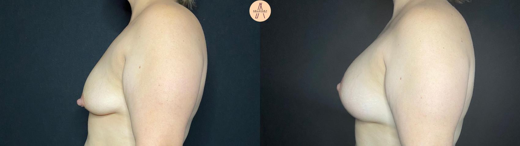 Before & After Breast Augmentation Case 73 Left Side View in San Antonio, Texas