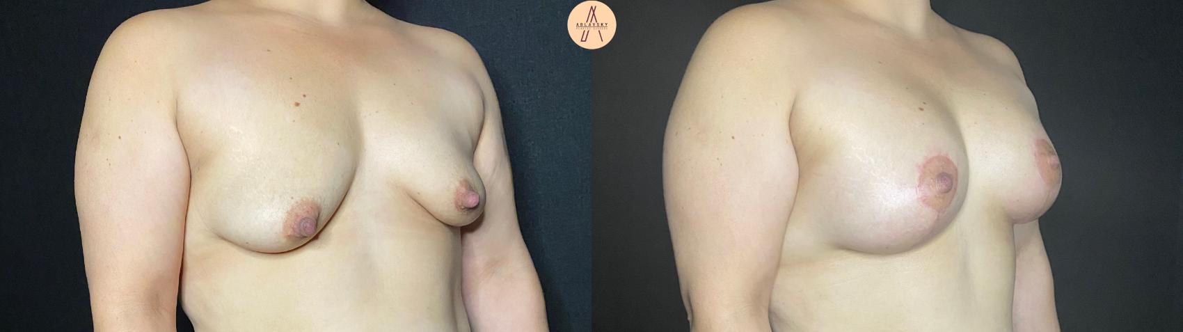Before & After Breast Augmentation Case 73 Right Oblique View in San Antonio, Texas