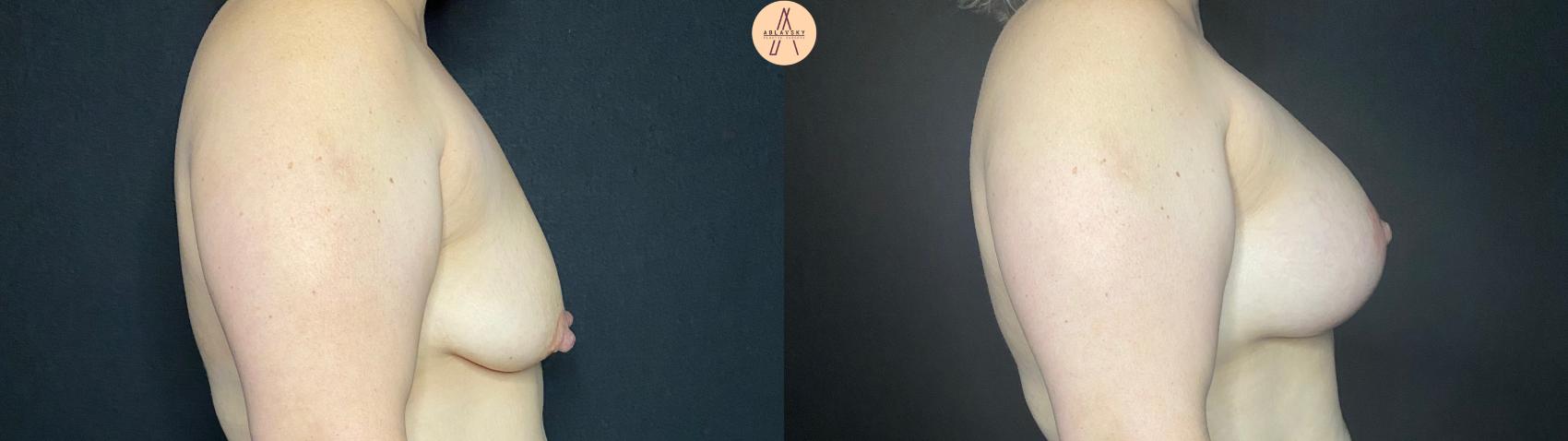 Before & After Breast Augmentation Case 73 Right Side View in San Antonio, Texas