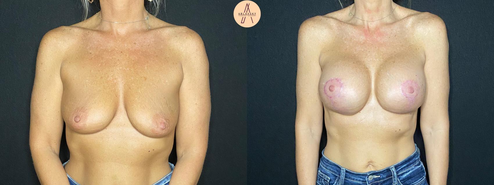 Before & After Breast Augmentation Case 79 Front View in San Antonio, Texas