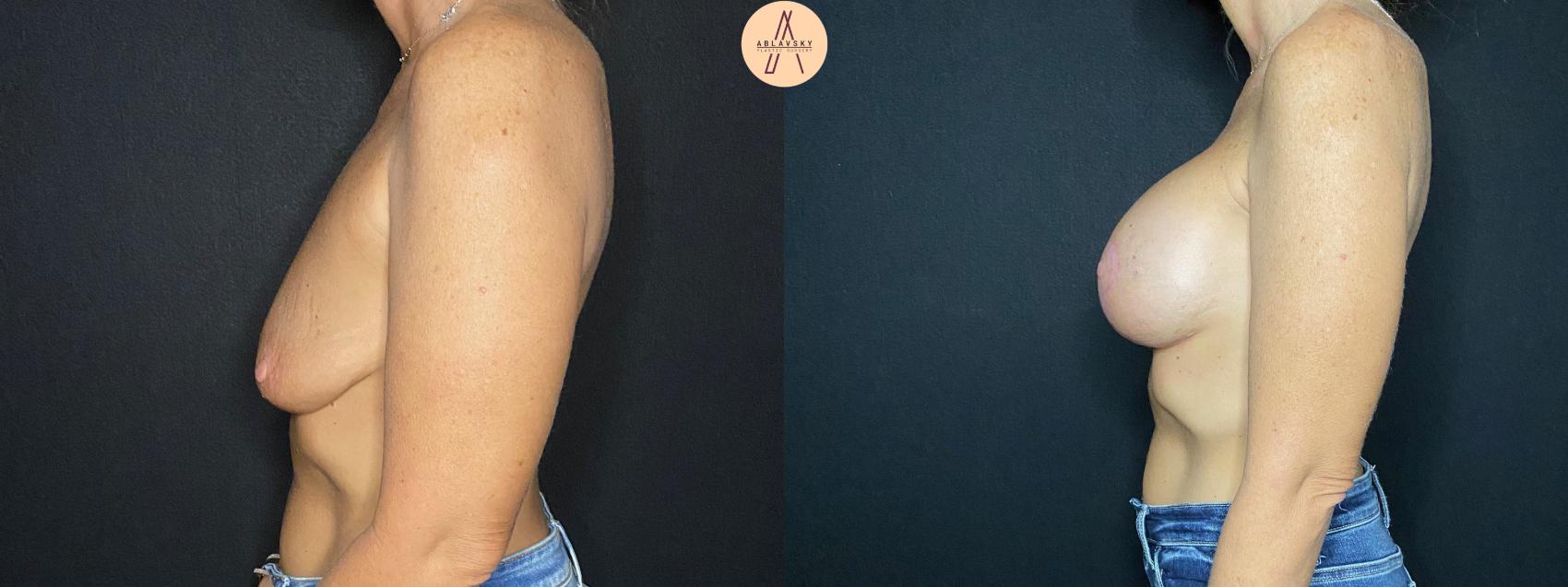 Before & After Breast Augmentation Case 79 Left Side View in San Antonio, Texas