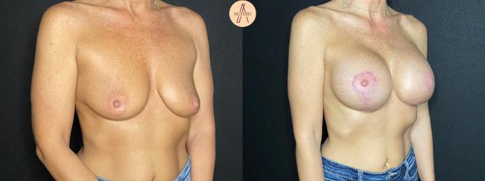 Before & After Breast Augmentation Case 79 Right Oblique View in San Antonio, Texas