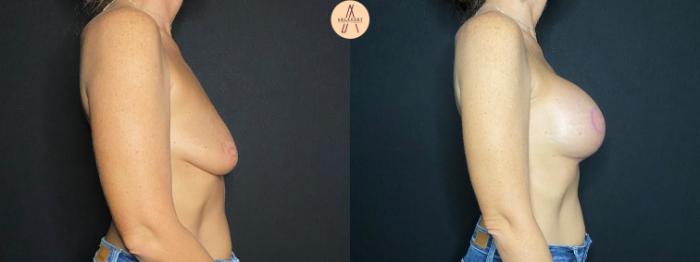 Before & After Breast Lift Case 79 Right Side View in San Antonio, Texas