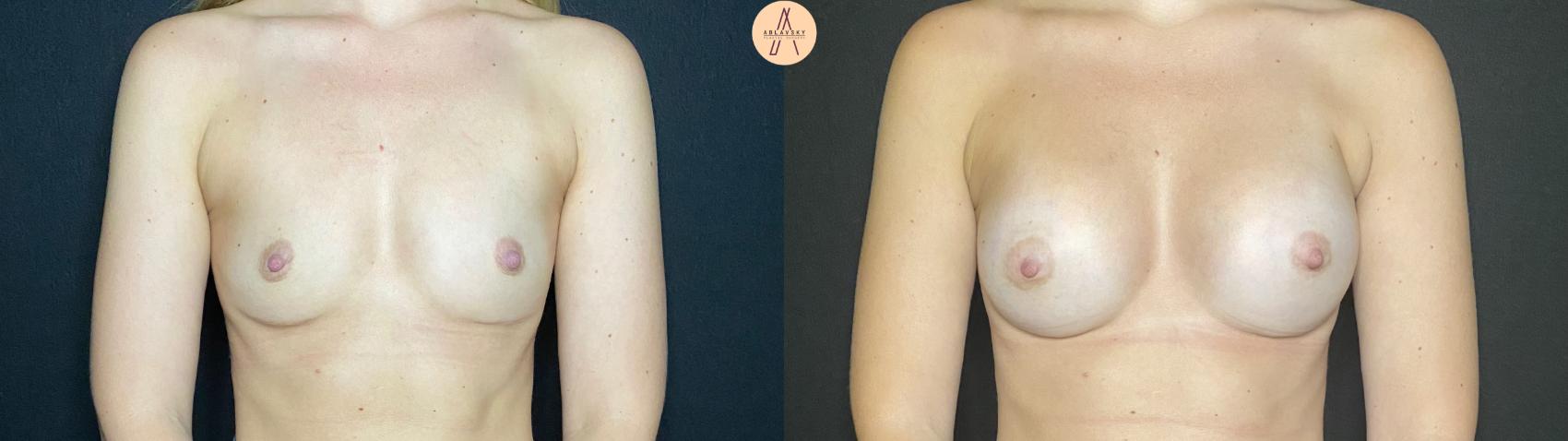 Before & After Breast Augmentation Case 99 Front View in San Antonio, Texas
