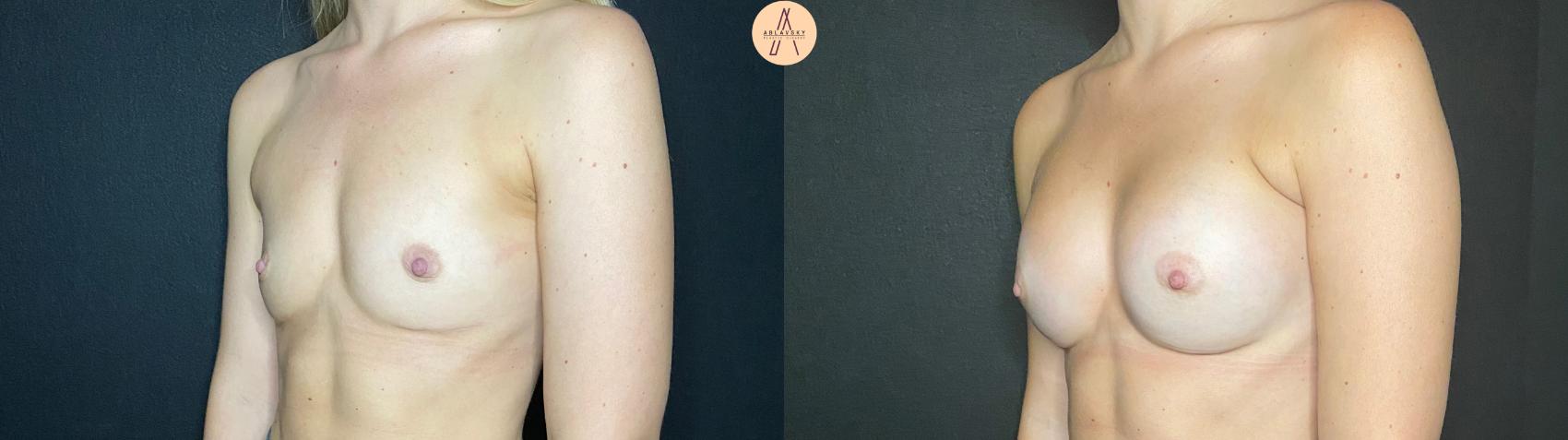 Before & After Breast Augmentation Case 99 Left Oblique View in San Antonio, Texas