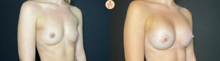 Before & After Breast Augmentation Case 99 Right Oblique View in San Antonio, Texas
