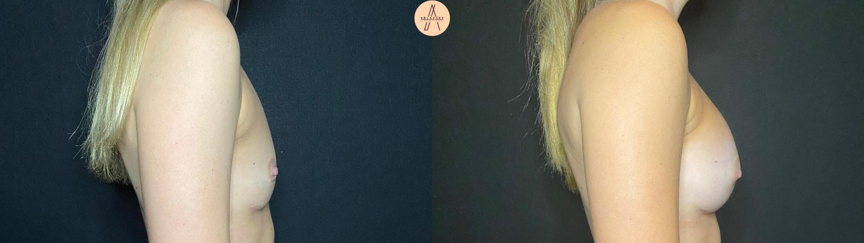 Before & After Breast Augmentation Case 99 Right Side View in San Antonio, Texas
