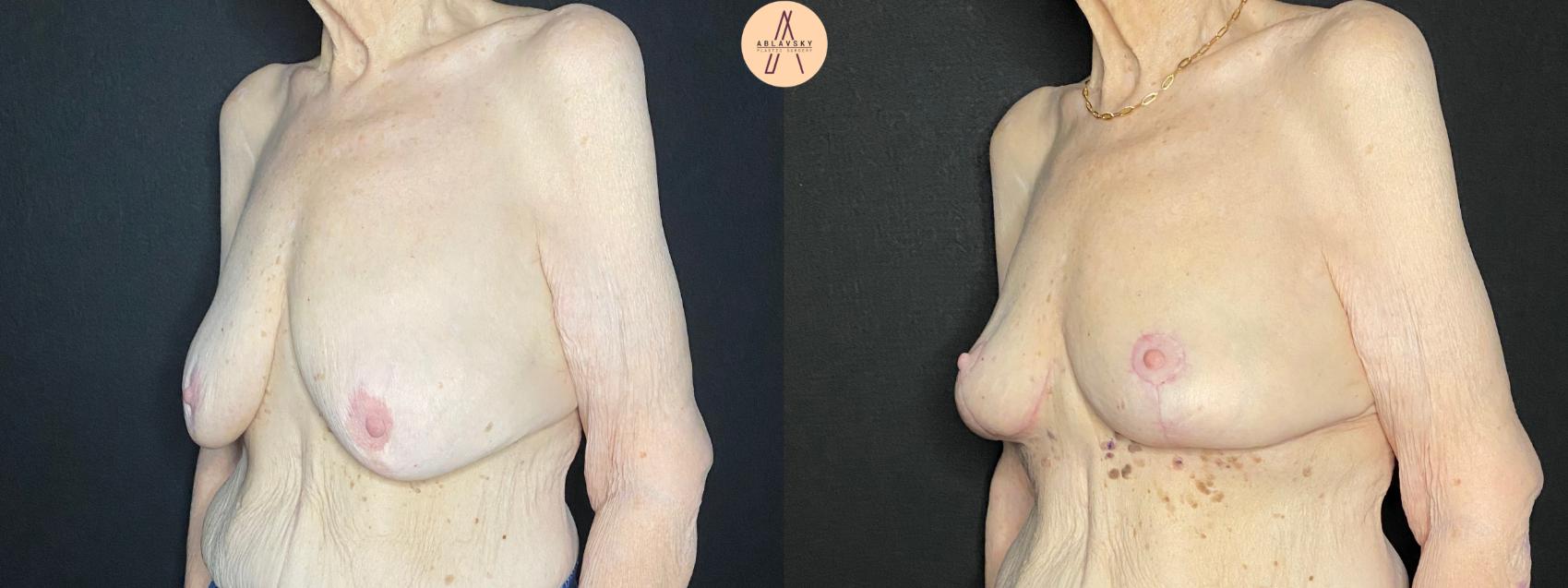 Before & After Breast Lift Case 109 Left Oblique View in San Antonio, Texas